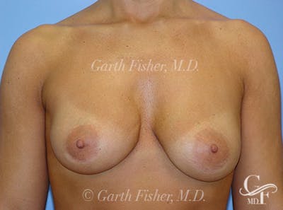 Breast Revision Before & After Gallery - Patient 318117 - Image 2