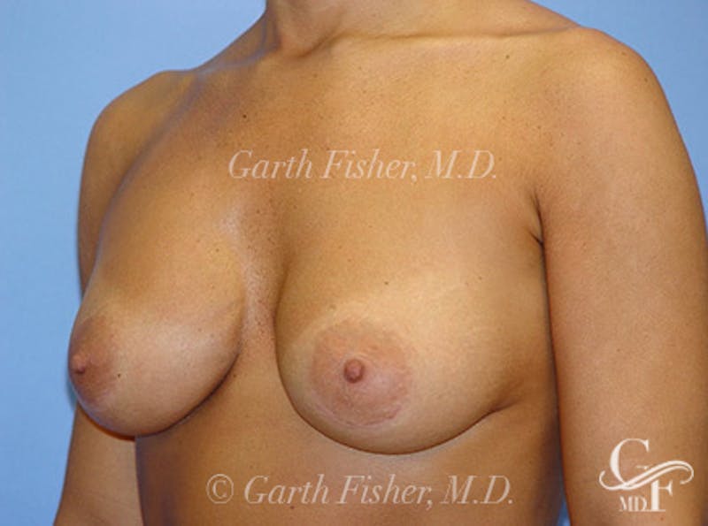Breast Revision Before & After Gallery - Patient 318117 - Image 4