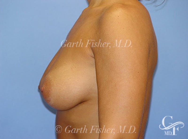 Breast Revision Before & After Gallery - Patient 318117 - Image 6