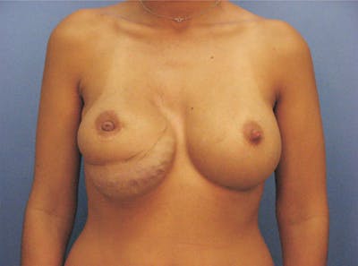 Breast Revision Before & After Gallery - Patient 326031 - Image 1