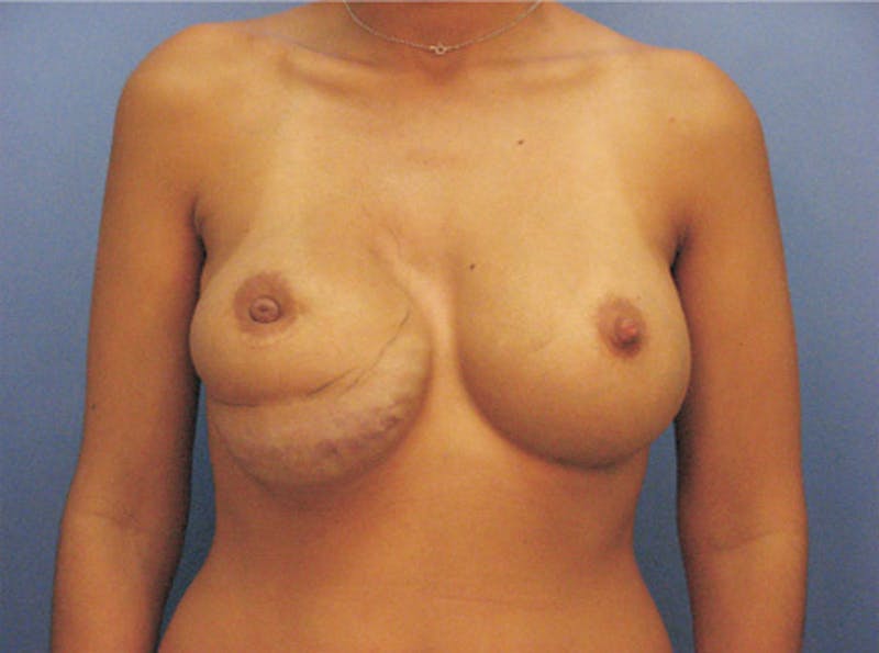 Breast Revision Before & After Gallery - Patient 326031 - Image 1