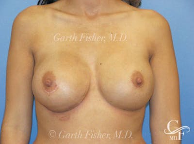 Breast Revision Before & After Gallery - Patient 326031 - Image 2