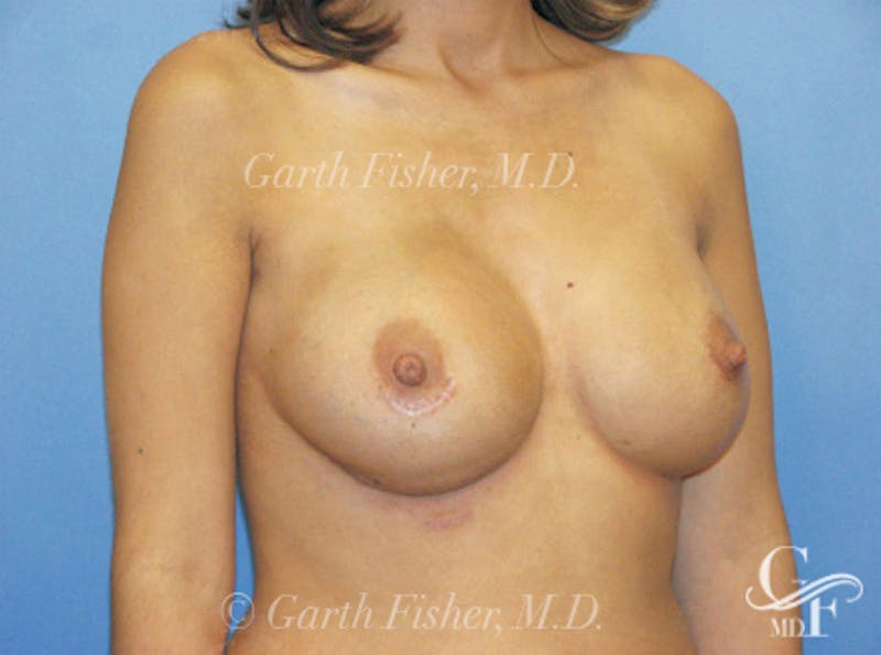 Breast Revision Before & After Gallery - Patient 326031 - Image 4