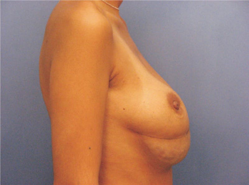Breast Revision Before & After Gallery - Patient 326031 - Image 5