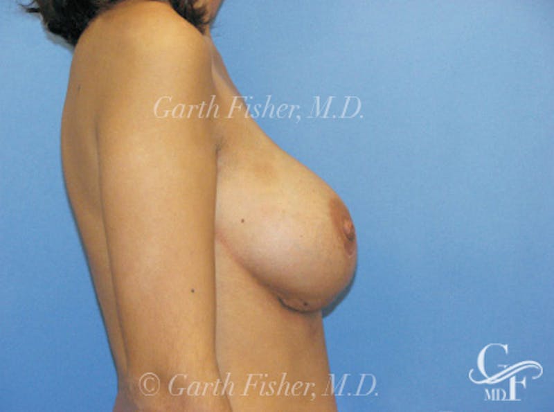 Breast Revision Before & After Gallery - Patient 326031 - Image 6