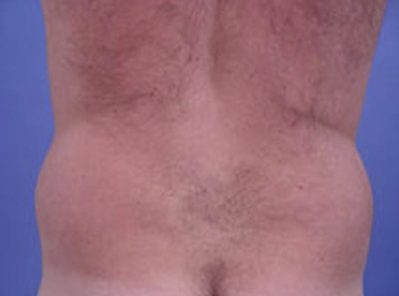 Body Contouring Before & After Gallery - Patient 326367 - Image 1