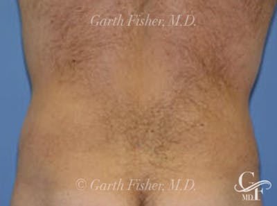 Body Contouring Before & After Gallery - Patient 326367 - Image 2
