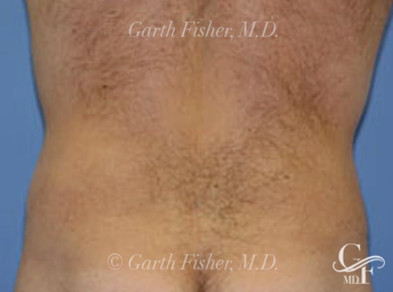 Body Contouring Before & After Gallery - Patient 326367 - Image 2