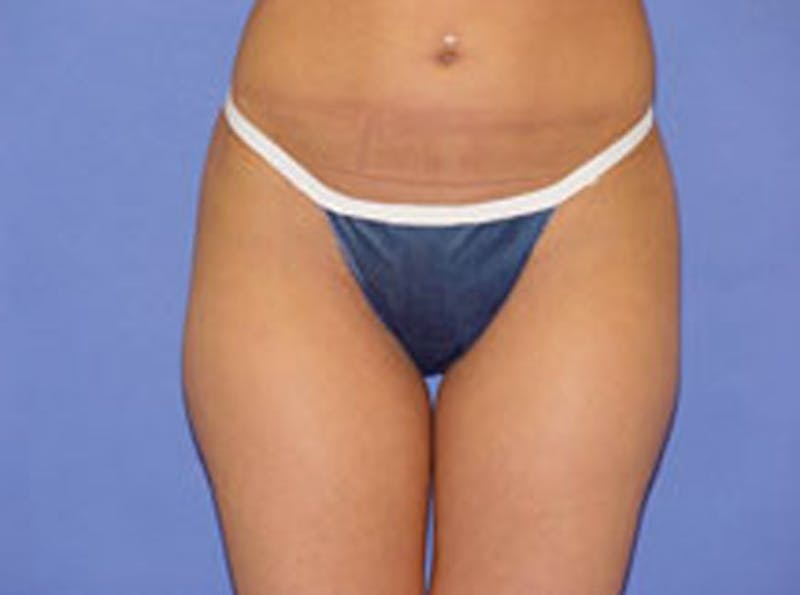 Body Contouring Before & After Gallery - Patient 341163 - Image 1
