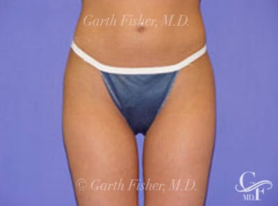 Body Contouring Before & After Gallery - Patient 341163 - Image 2