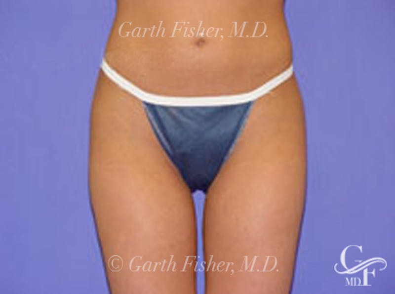 Body Contouring Before & After Gallery - Patient 341163 - Image 2