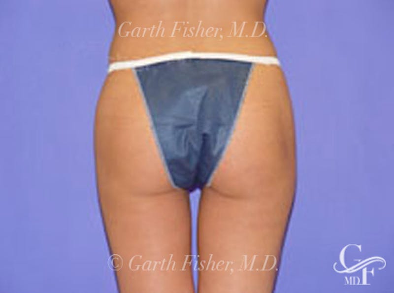 Body Contouring Before & After Gallery - Patient 341163 - Image 4