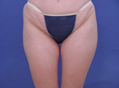 Body Contouring Before & After Gallery - Patient 252421 - Image 1