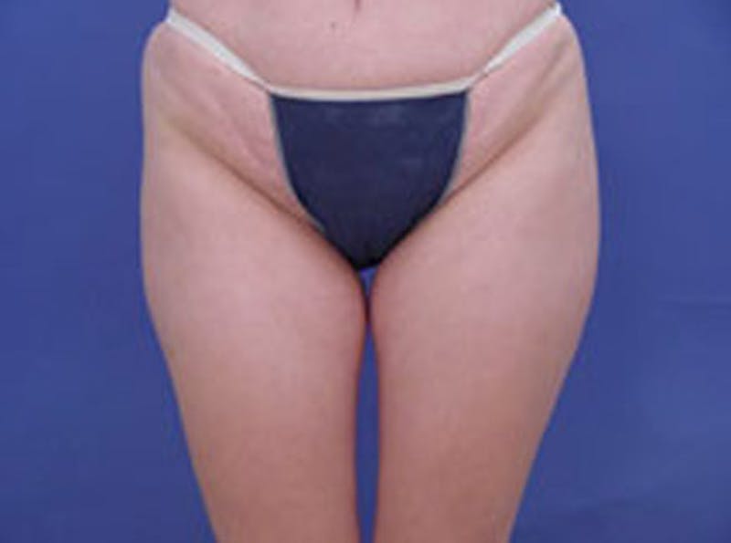 Body Contouring Before & After Gallery - Patient 252421 - Image 1