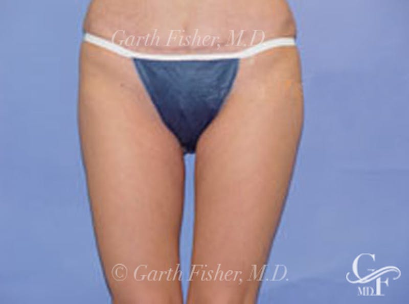 Body Contouring Before & After Gallery - Patient 252421 - Image 2