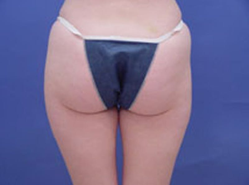 Body Contouring Before & After Gallery - Patient 252421 - Image 3