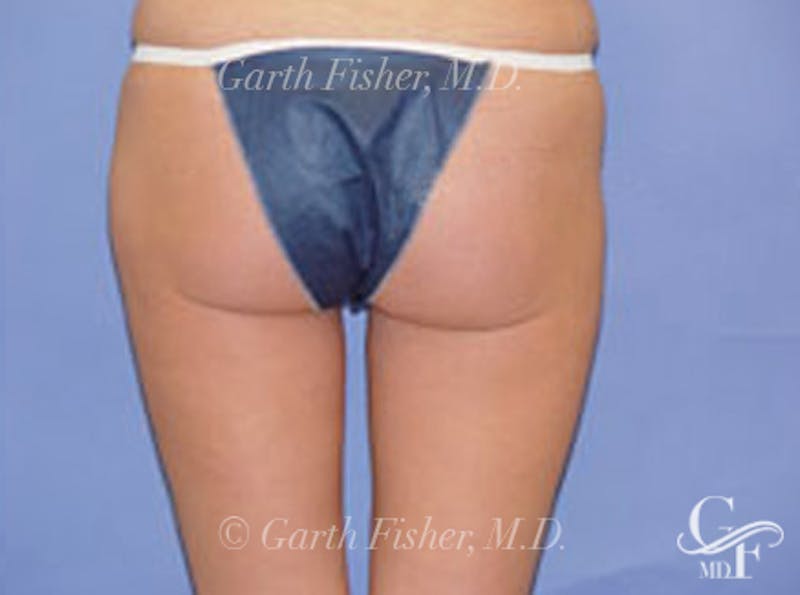 Body Contouring Before & After Gallery - Patient 252421 - Image 4