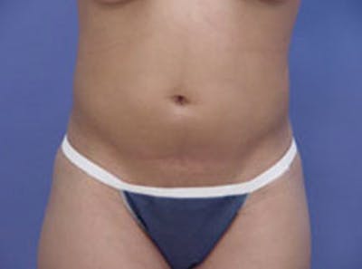 Body Contouring Before & After Gallery - Patient 397490 - Image 1