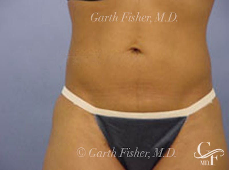 Body Contouring Before & After Gallery - Patient 397490 - Image 2