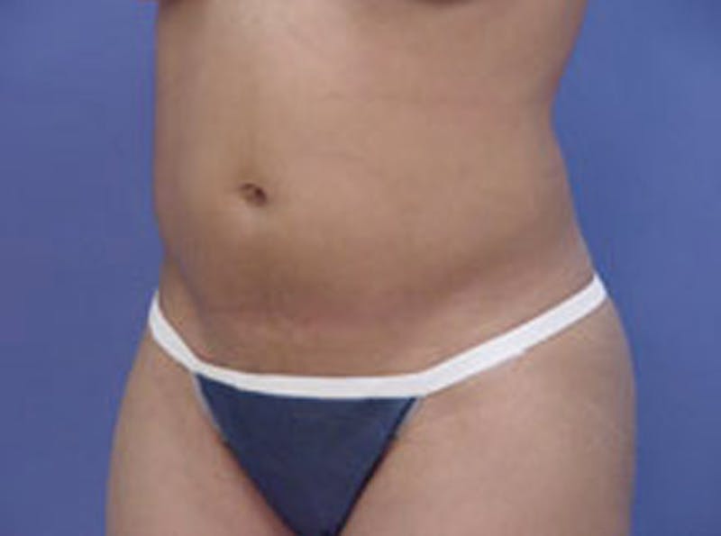 Body Contouring Before & After Gallery - Patient 397490 - Image 3