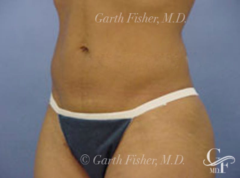 Body Contouring Before & After Gallery - Patient 397490 - Image 4