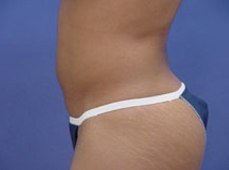 Body Contouring Before & After Gallery - Patient 397490 - Image 5