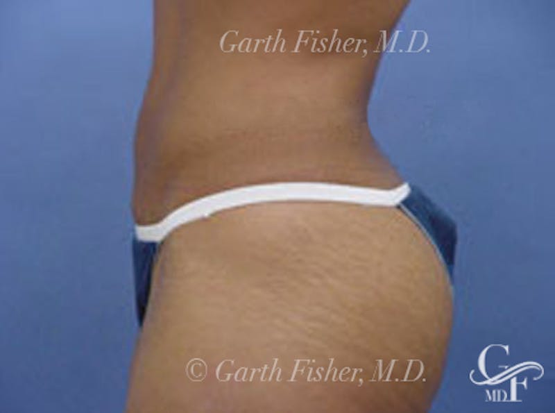 Body Contouring Before & After Gallery - Patient 397490 - Image 6