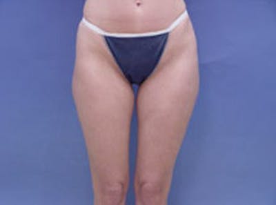 Body Contouring Before & After Gallery - Patient 945514 - Image 1