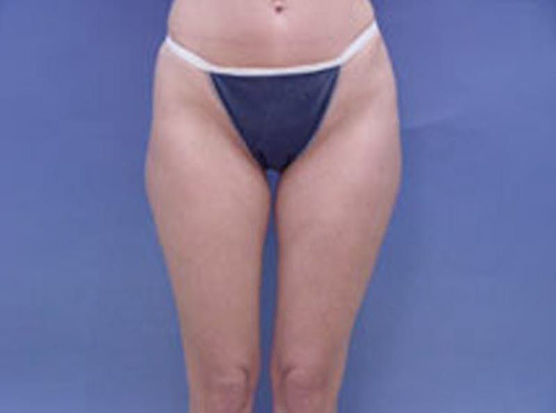 Body Contouring Before & After Gallery - Patient 945514 - Image 1