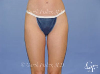 Body Contouring Before & After Gallery - Patient 945514 - Image 2