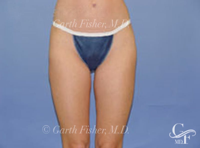 Body Contouring Before & After Gallery - Patient 945514 - Image 2