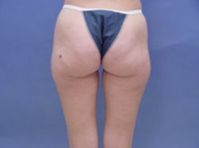 Body Contouring Before & After Gallery - Patient 945514 - Image 3