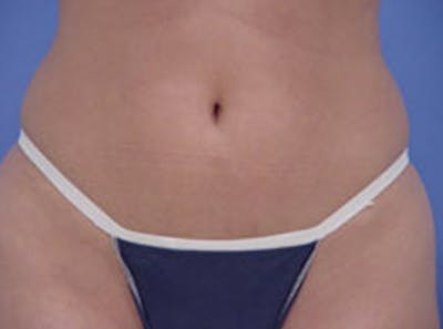 Body Contouring Before & After Gallery - Patient 410817 - Image 1