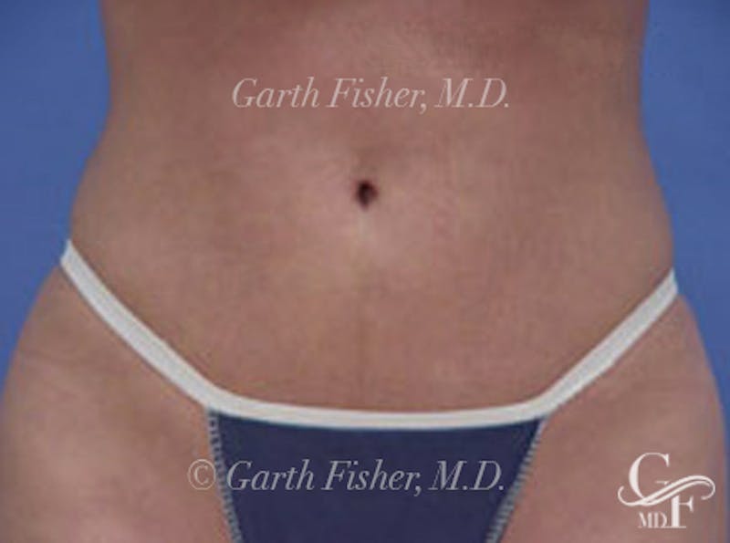 Body Contouring Before & After Gallery - Patient 410817 - Image 2