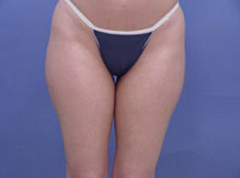 Body Contouring Before & After Gallery - Patient 410817 - Image 3