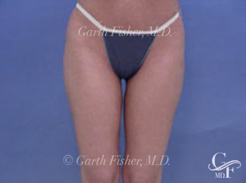 Body Contouring Before & After Gallery - Patient 410817 - Image 4