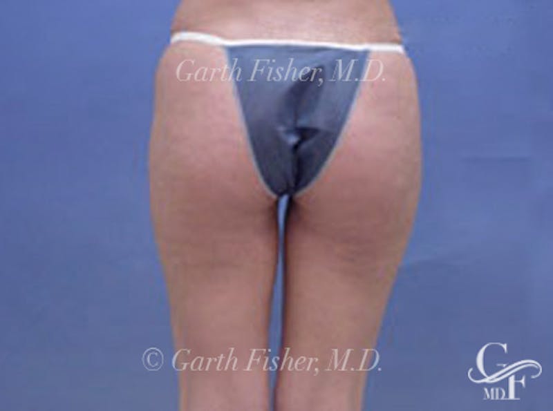 Body Contouring Before & After Gallery - Patient 410817 - Image 6