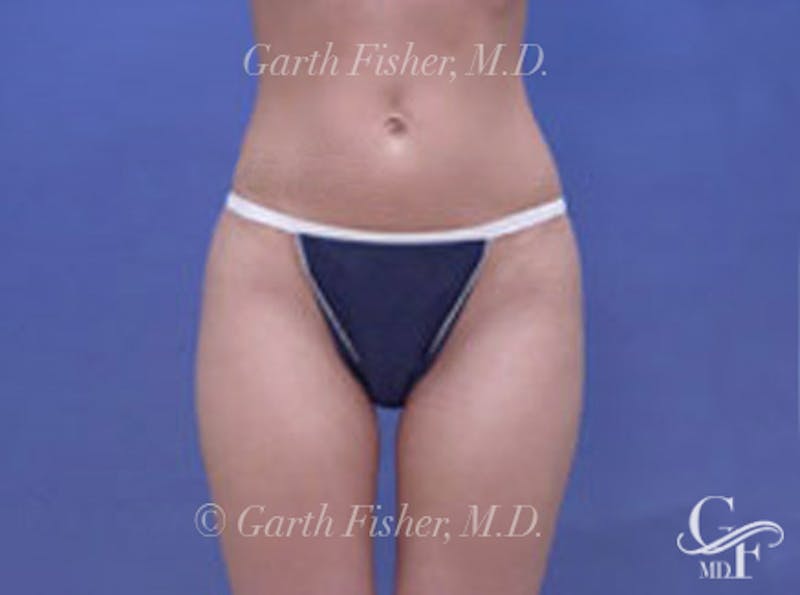 Body Contouring Before & After Gallery - Patient 203627 - Image 2
