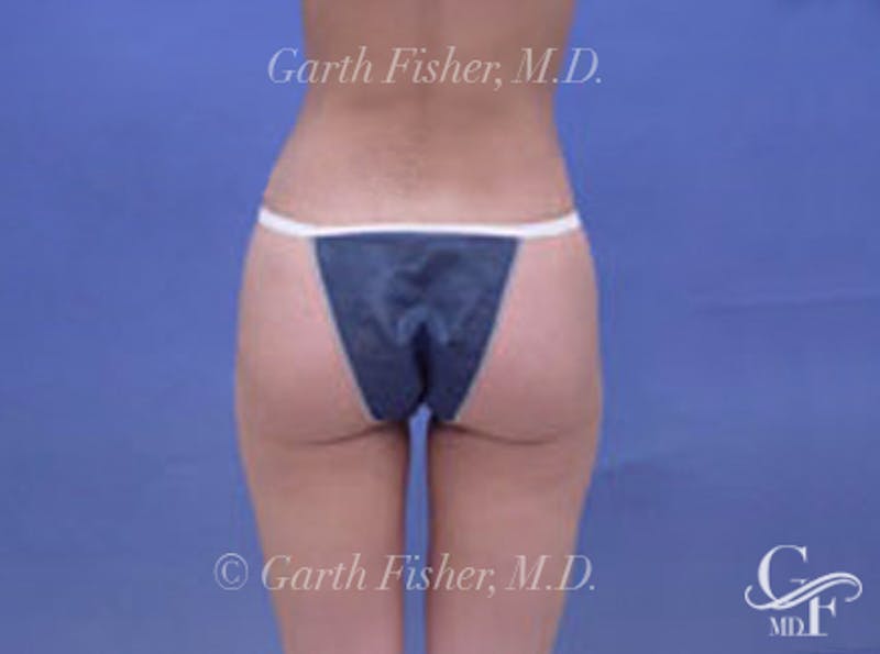 Body Contouring Before & After Gallery - Patient 203627 - Image 4
