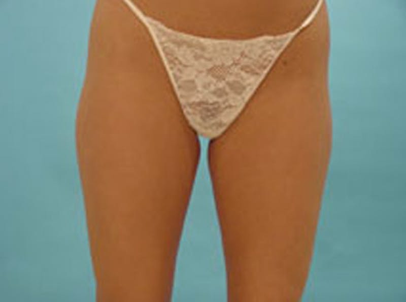 Body Contouring Before & After Gallery - Patient 347268 - Image 1