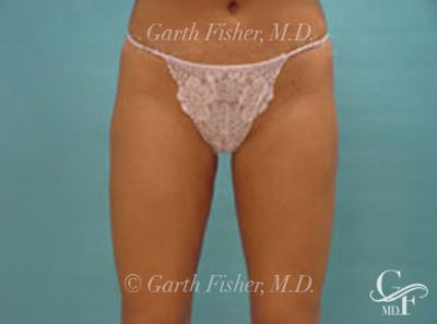Body Contouring Before & After Gallery - Patient 347268 - Image 2
