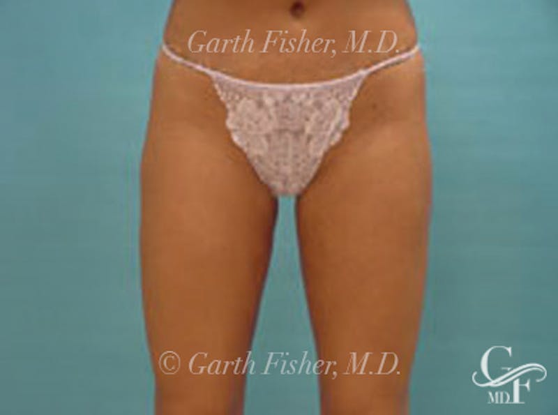 Body Contouring Before & After Gallery - Patient 347268 - Image 2
