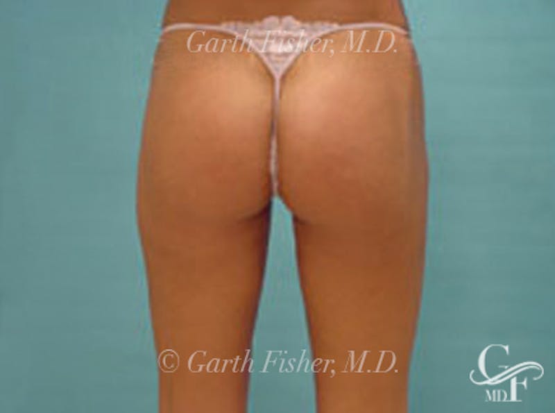 Body Contouring Before & After Gallery - Patient 347268 - Image 4