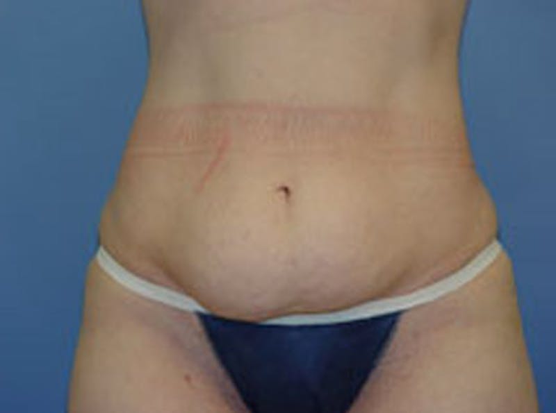 Tummy Tuck Before & After Gallery - Patient 237272 - Image 1