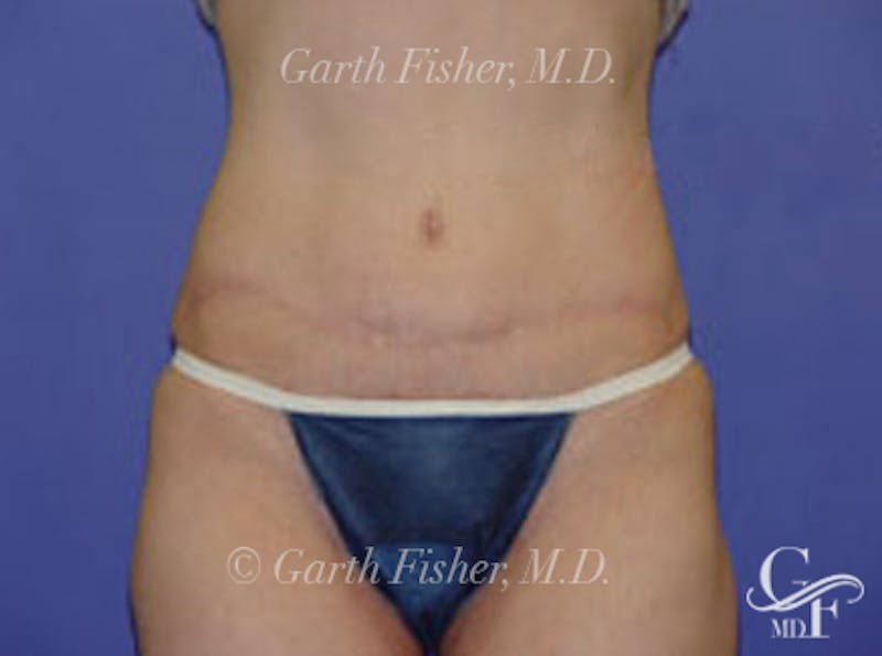 Tummy Tuck Before & After Gallery - Patient 237272 - Image 2