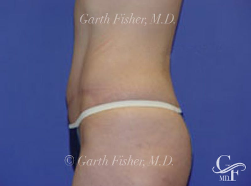 Tummy Tuck Before & After Gallery - Patient 237272 - Image 4