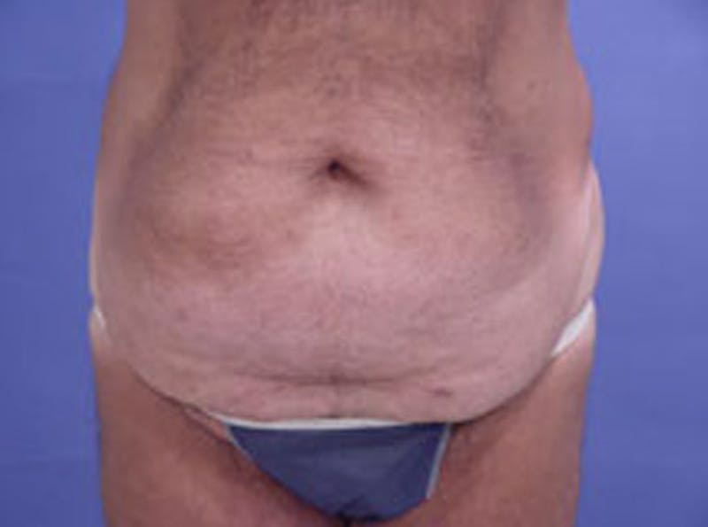 Tummy Tuck Before & After Gallery - Patient 242707 - Image 1