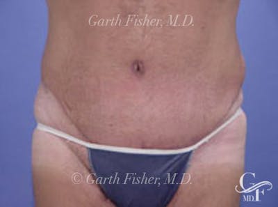 Tummy Tuck Before & After Gallery - Patient 242707 - Image 2