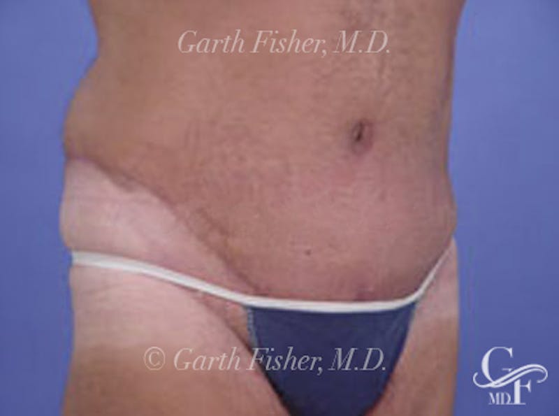Tummy Tuck Before & After Gallery - Patient 242707 - Image 4
