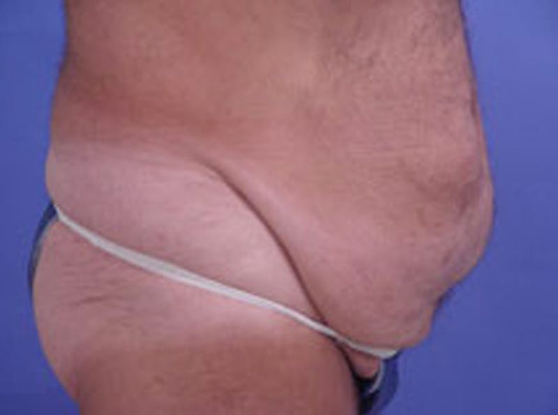 Tummy Tuck Before & After Gallery - Patient 242707 - Image 5